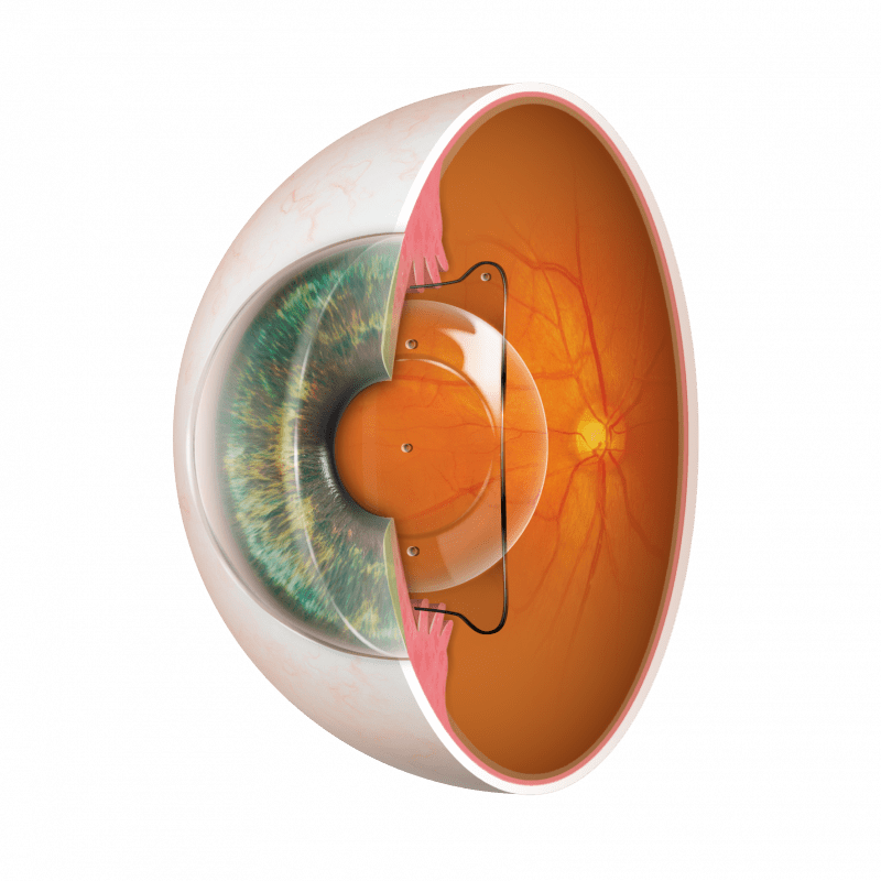 Факичные интраокулярные линзы