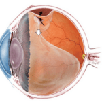 Отслойка сетчатки