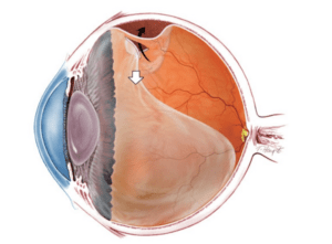 Отслойка сетчатки
